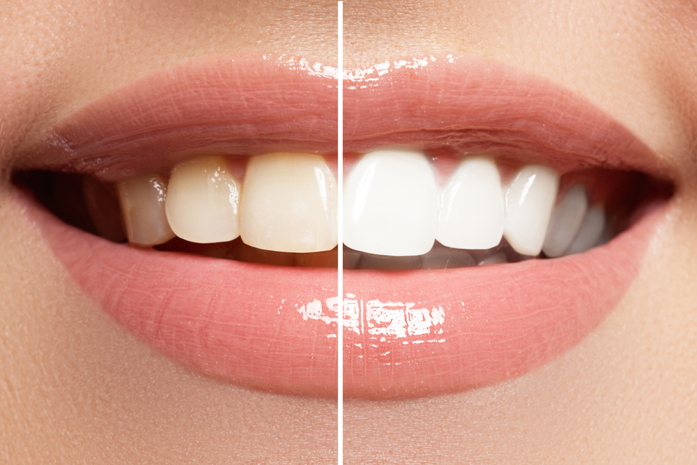 The Latest Advances in Cosmetic Dentistry You Should Know About