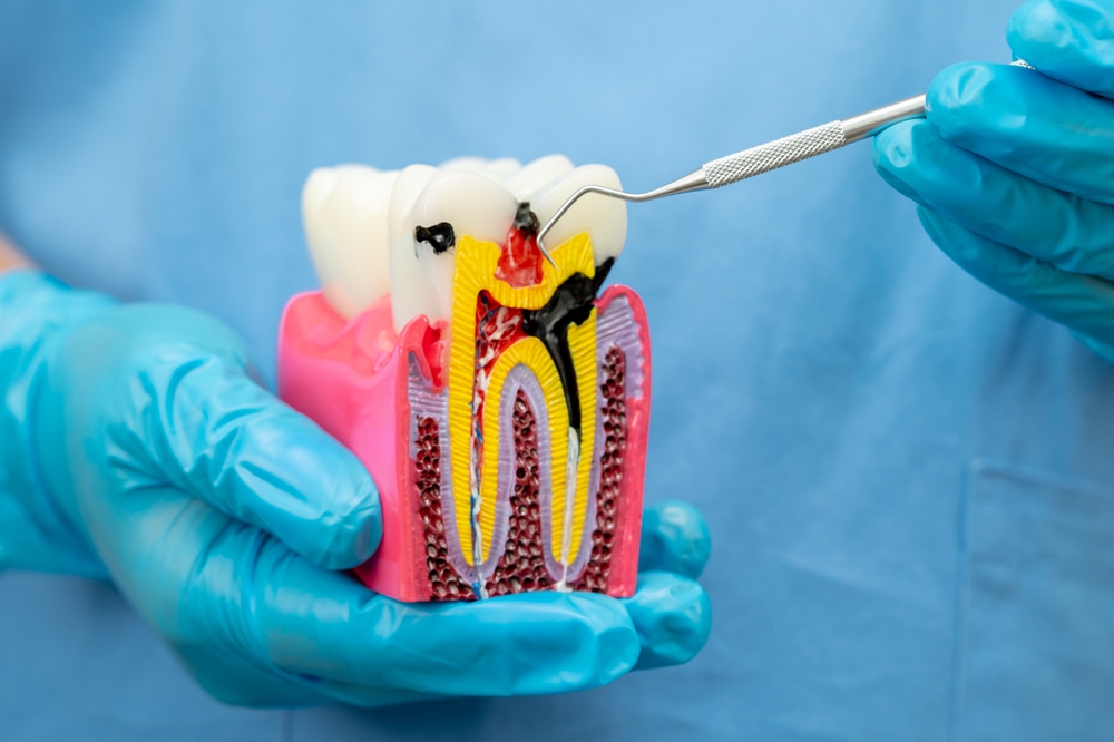 Benefits of Dental Implants