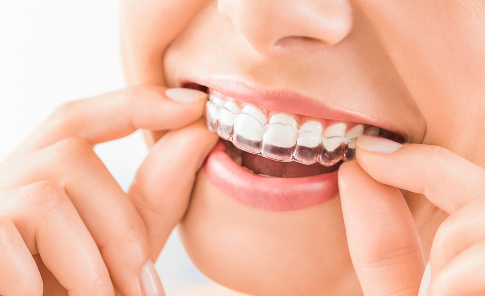 How Does Invisalign Work?