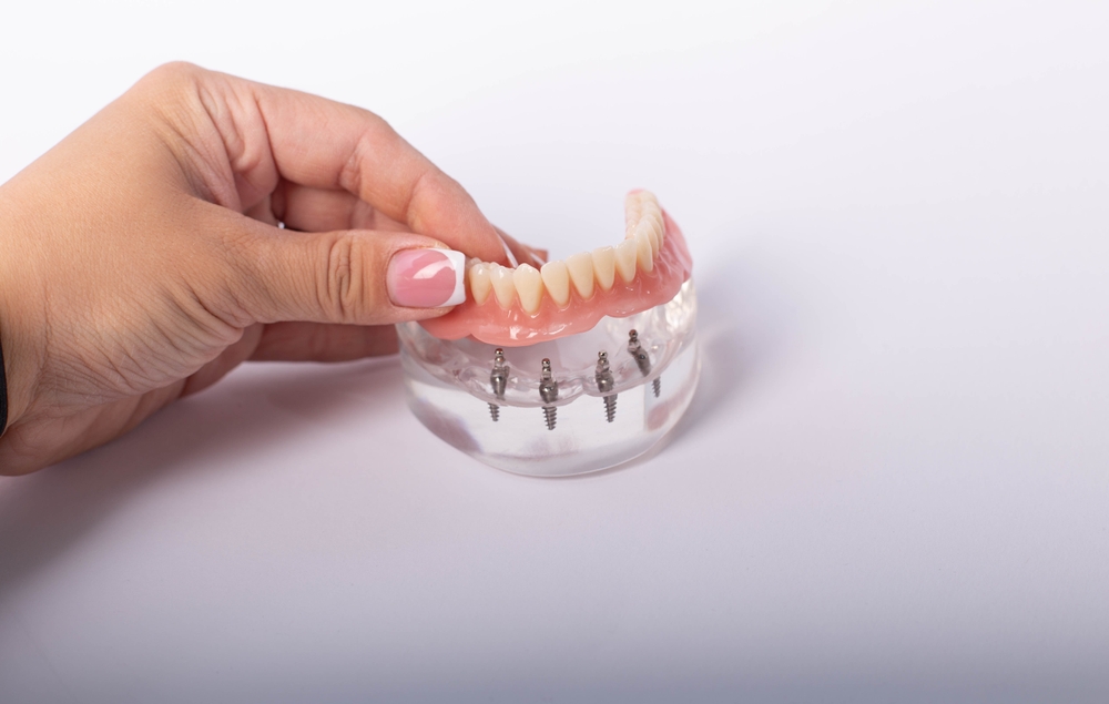 Implant-Supported Dentures