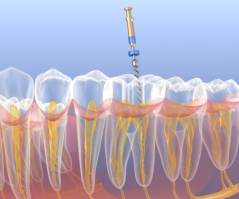 Endodontic,root,canal,treatment,process.,medically,accurate,tooth,3d,illustration.